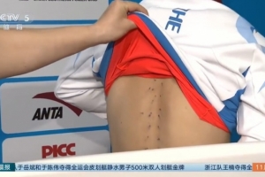 石智勇：我現(xiàn)在背上全部都是針眼，還一直控制不住疼痛